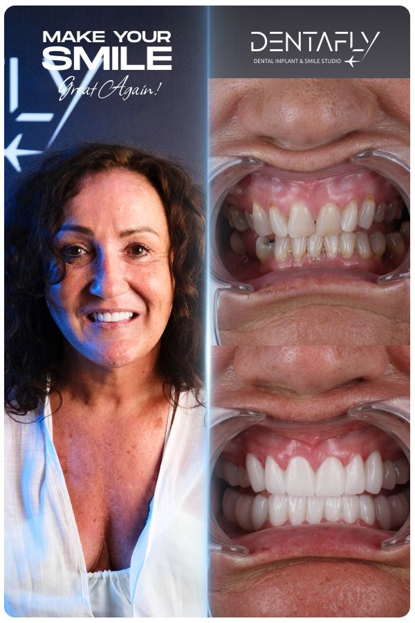 Dental implant and smile-design before and after — clinic group case 1