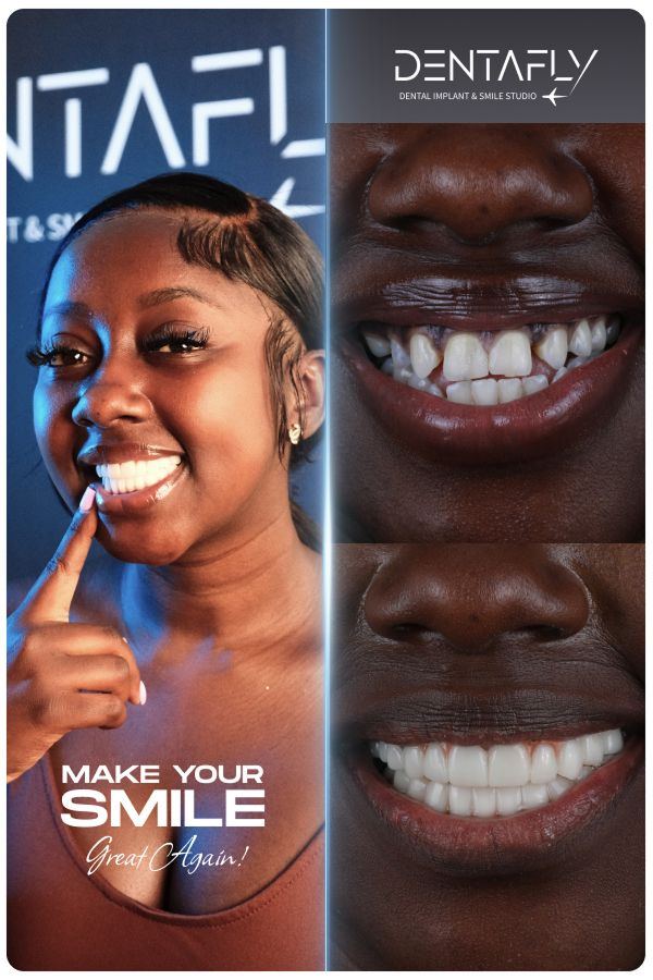 Dental implant and smile-design before and after — clinic group case 2