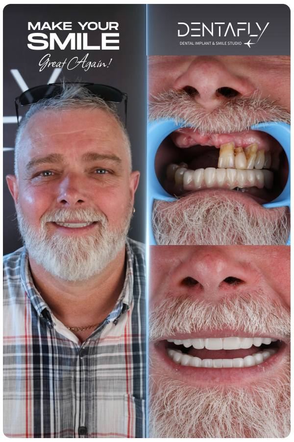 Dental implant and smile-design before and after — clinic group case 3