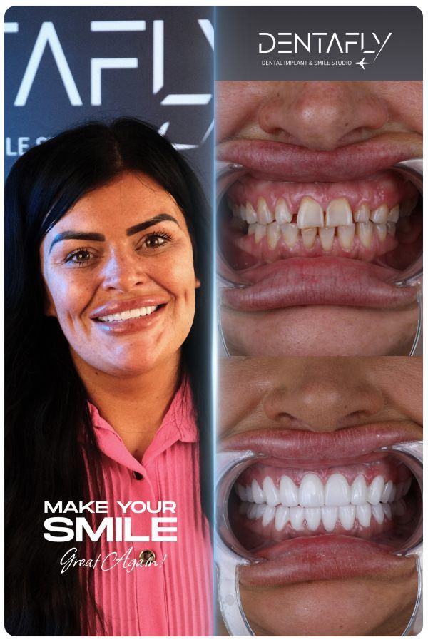 Dental implant and smile-design before and after — clinic group case 4