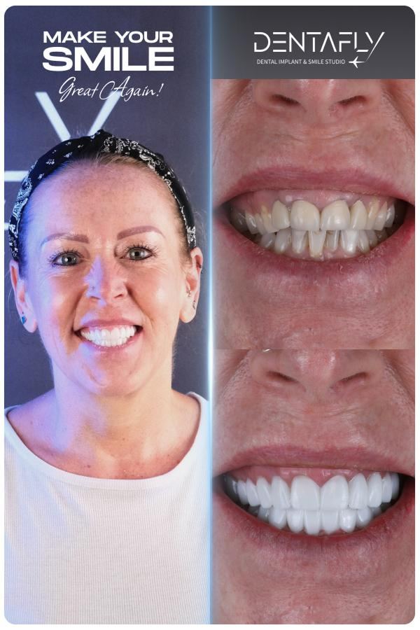 Dental implant and smile-design before and after — clinic group case 5