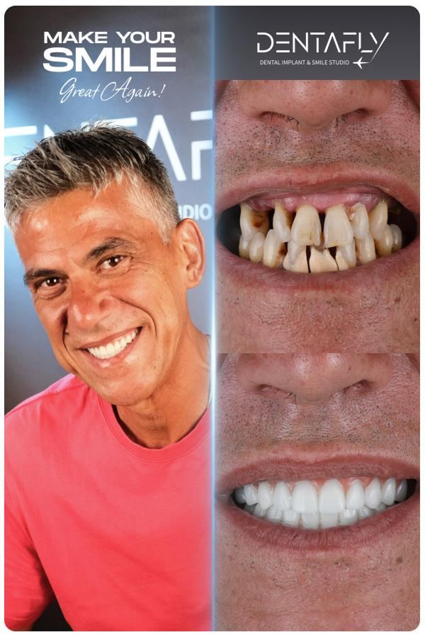 Dental implant and smile-design before and after — clinic group case 6
