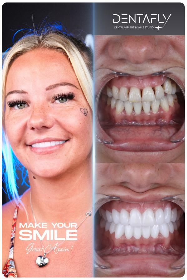 Dental implant and smile-design before and after — clinic group case 9