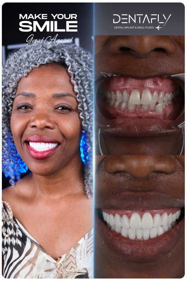 Dental implant and smile-design before and after — clinic group case 10