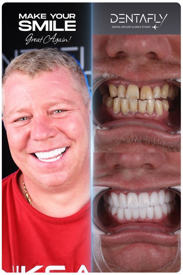 Dental implant and smile-design before and after — clinic group case 11
