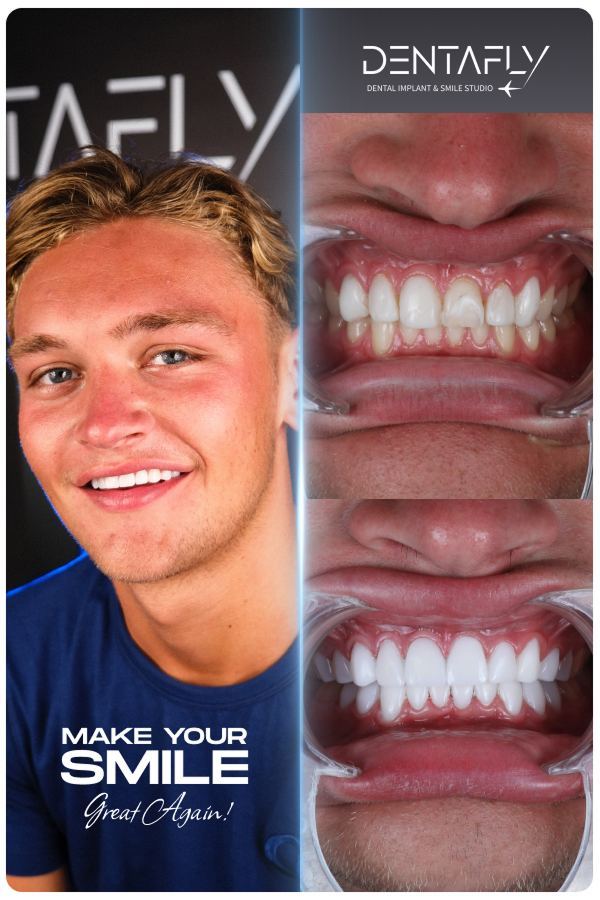 Dental implant and smile-design before and after — clinic group case 12